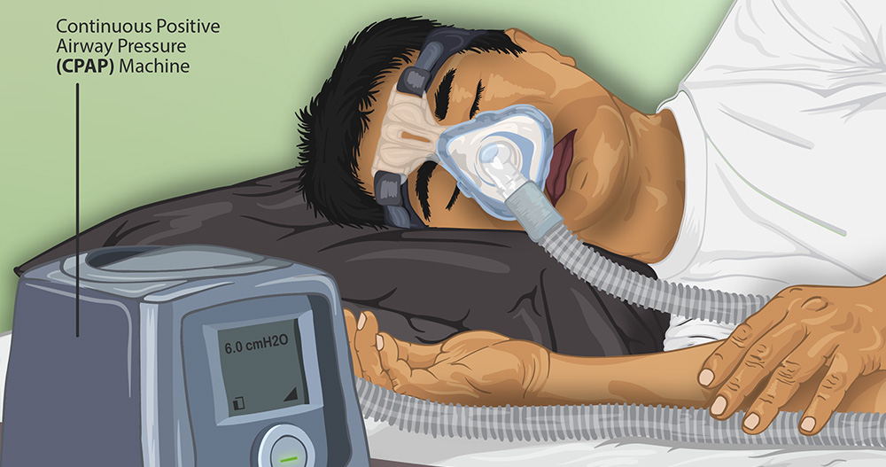 cpap therapy